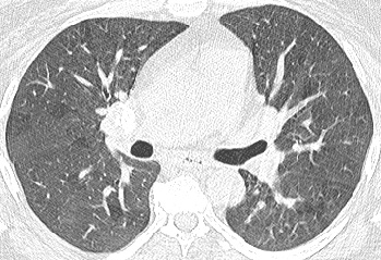 Steroid drugs for pneumonia