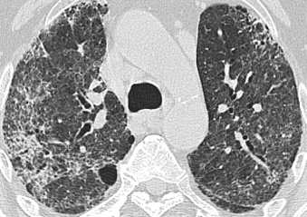 Lung disease treatment steroids