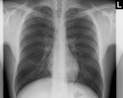 Normal Chest X Ray Module Train Your Eye