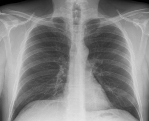 Normal Chest X Ray Module Train Your Eye