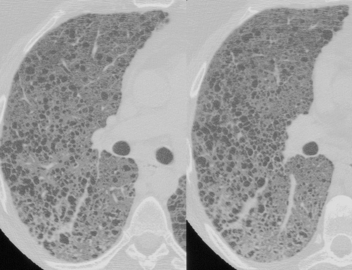 lam chest ct radiology