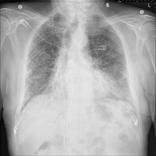 Home ChestX ray The Art And Science Of Thoracic Imaging Home chestx ray the art and science of thoracic imaging